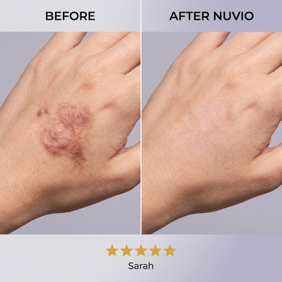 Nuvio Silicone Scar Sheets